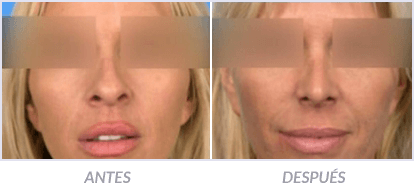 Rinoplastia-21-Cirujano-Plastico-Mexico-DF-Dr-Victor-Pera-Galvez